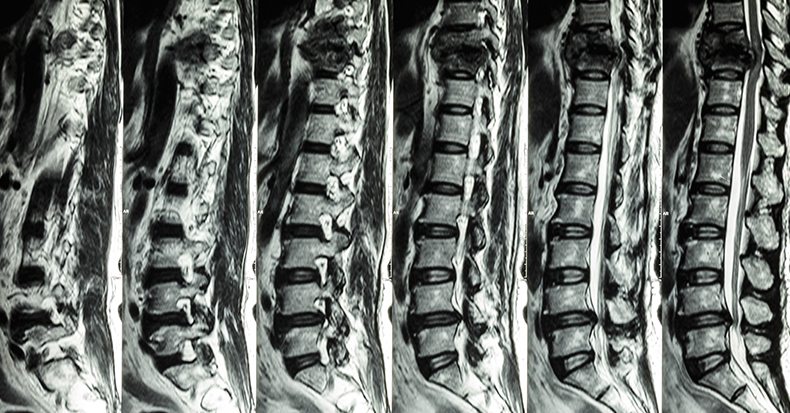 Truths & Myths of MRI for Low Back Pain