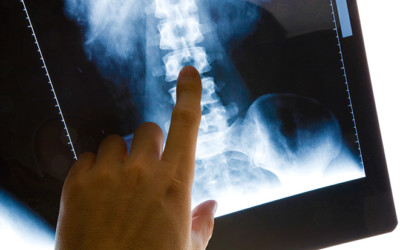 What Can X-Rays Tell You About Whiplash? Lacey Chiropractor Reveals