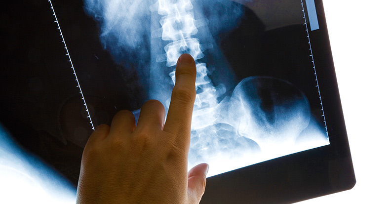 What Can X-Rays Tell You About Whiplash? Lacey Chiropractor Reveals